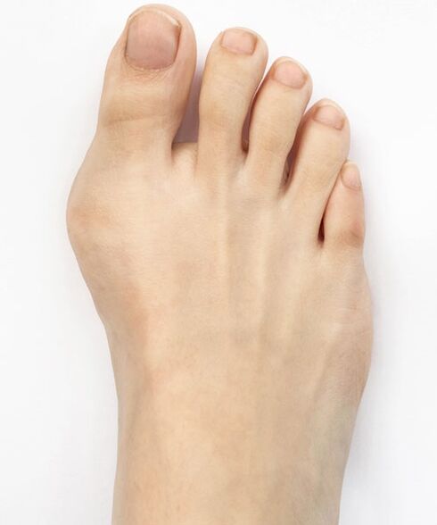 hallux valgus πριν χρησιμοποιήσετε το σπρέι Hondro Sol Valgus