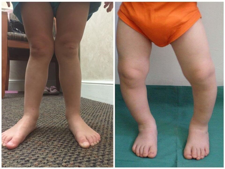 Η παραμόρφωση του Valgus στα παιδιά προκαλεί