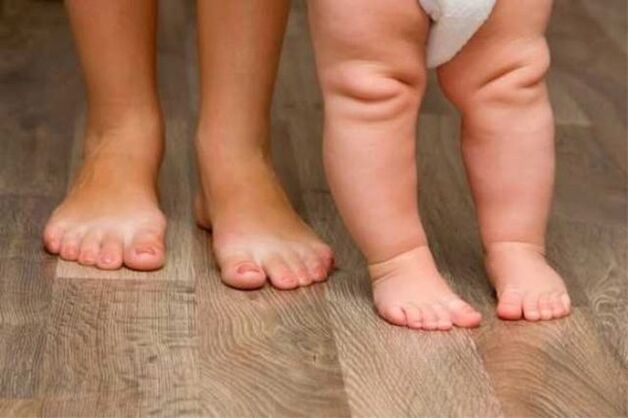Παραμόρφωση Valgus