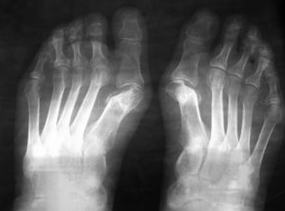 Ενδείξεις για τις πράξεις κάτω από το Valgus του ποδιού