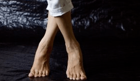 Παραμόρφωση Valgus