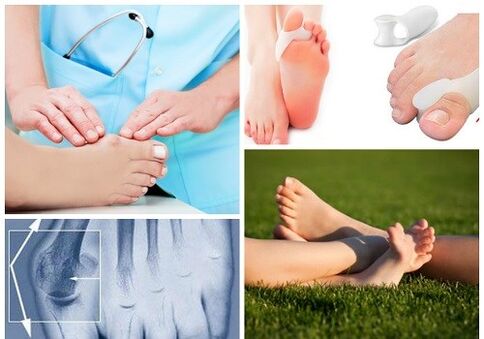 Θεραπεία της παραμόρφωσης Valgus