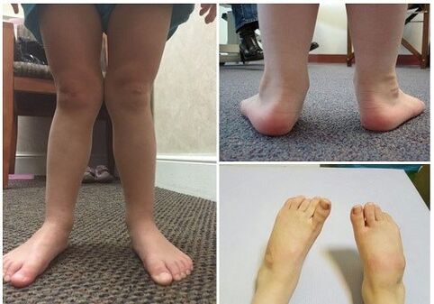 Παραμόρφωση Valgus σε παιδιά